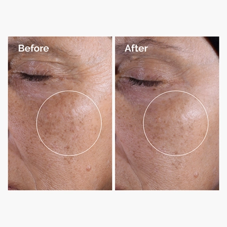 The Ordinary - Glycolic Acid 7% Exfoliating Toner - Peeling Gesichtswasser mit 7% Glykolsäure - 100ml