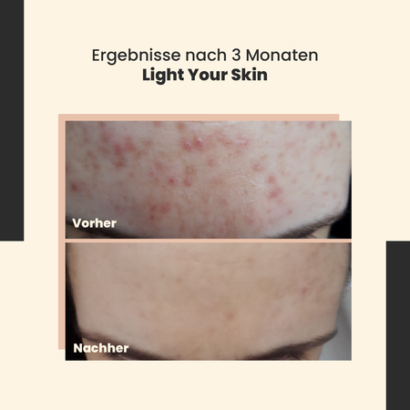 SkinTra - Light Your Skin - Serum mit Vitamin C 20% und Ferulasäure - 30ml