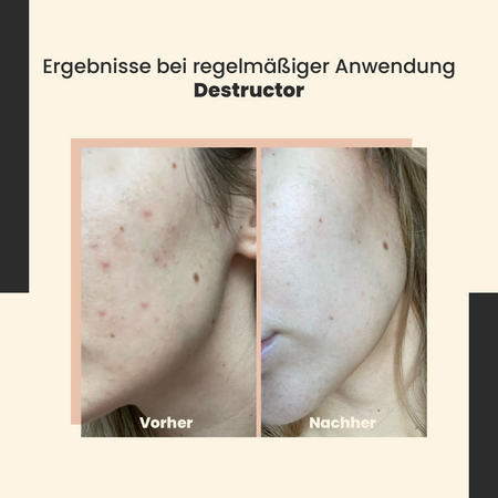 SkinTra - Destructor - Ganzjähriges Säurepeeling 24% - 30ml