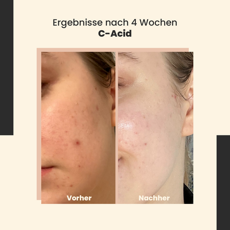 SkinTra - C-Acid -  Säurebehandlung mit Vitamin C - 30ml