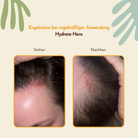 HairTry - Hydrate Hero - Feuchtigkeitsspendende und lindernde Kopfhauteinreibung mit NMF-Komplex und Ectoine - 100ml