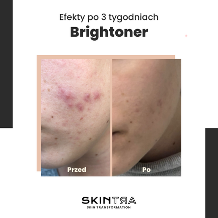 SkinTra - Brightoner - Ganzjähriges Gesichtswasser mit Säuren 9% - 100ml