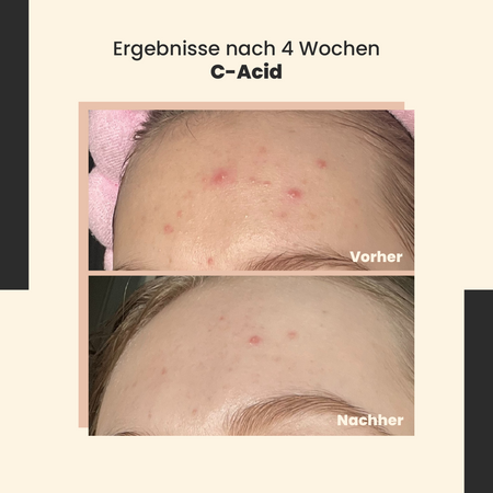 SkinTra - C-Acid -  Säurebehandlung mit Vitamin C - 30ml