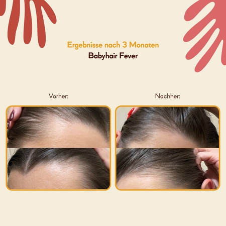 HairTry - Babyhair Fever - Haarwachstum Wärmende Einreibung - 200ml